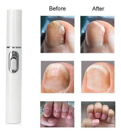 LÁSER PORTÁTIL BIKENDA®